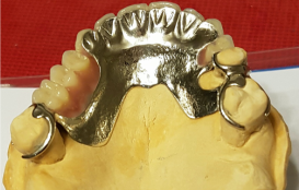 Cobalt chromium upper denture with metal backing