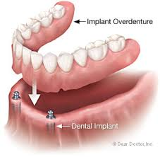 Implant over denture
